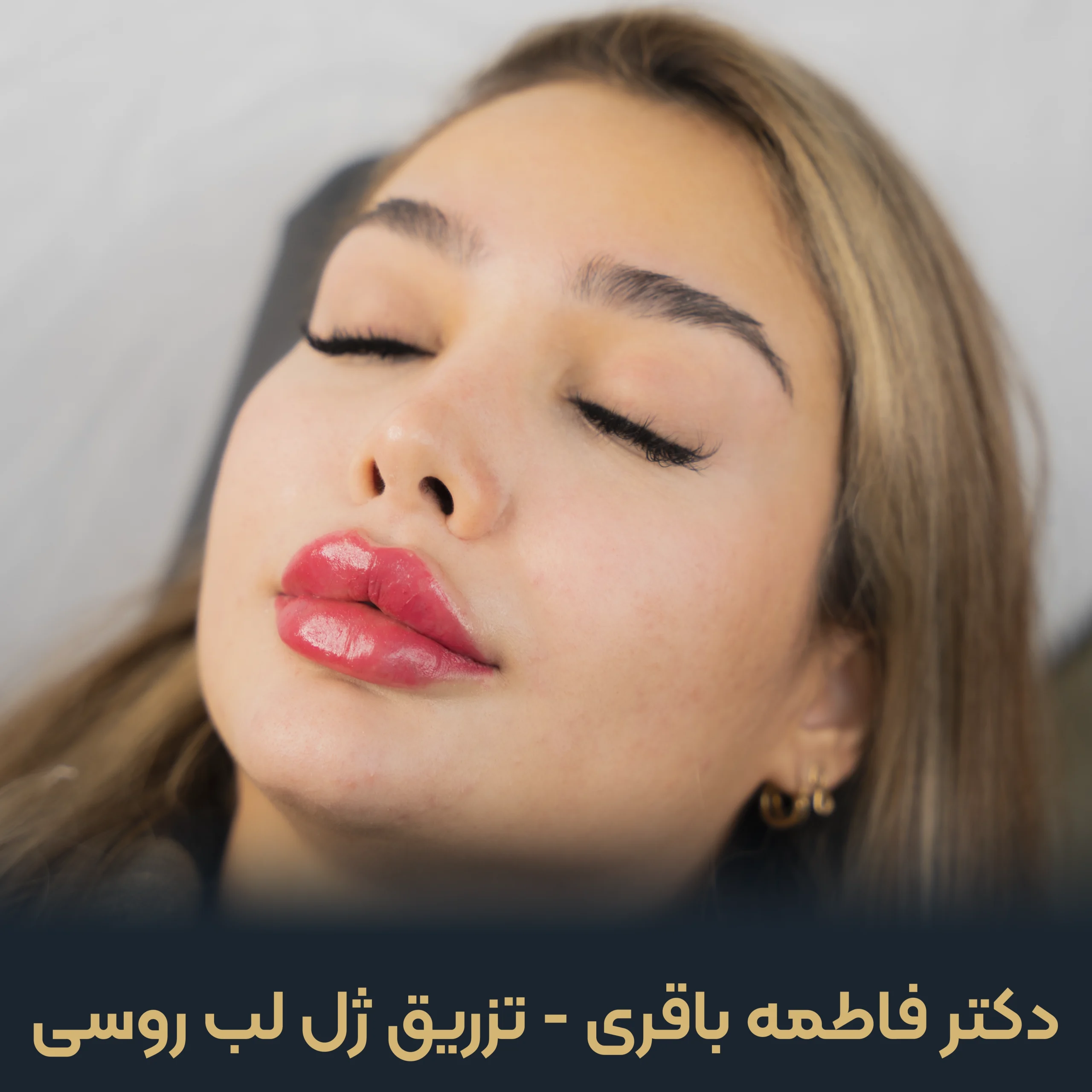 نمونه تزریق ژل لب روسی