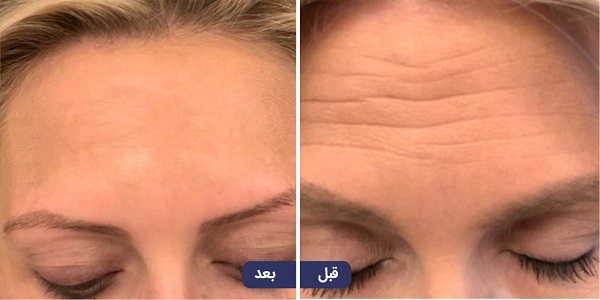 تفاوتهای بین فیلر، ژل و بوتاکس و کاربردهای آنها کاربردهای بوتاکس