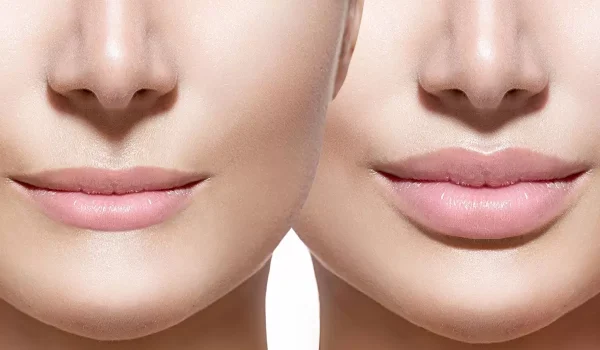 تفاوت ژل لب روسی با ژل لب طبیعی