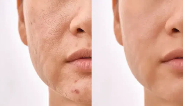 تفاوت مزوتراپی با میکرونیدلینگ