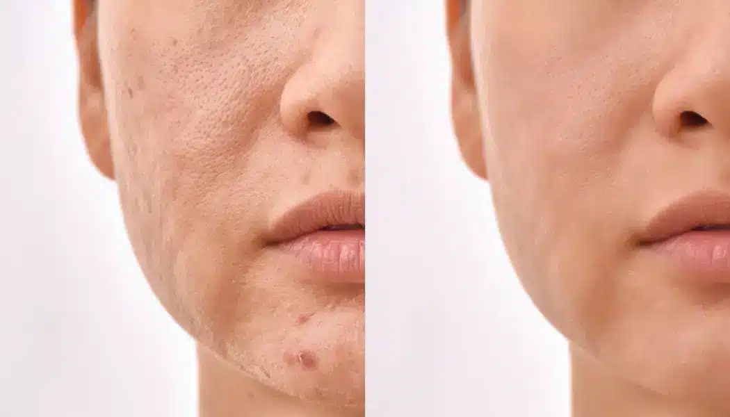 تفاوت مزوتراپی با میکرونیدلینگ