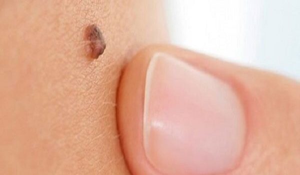 تفاوت خال و زگیل؛ چگونه تشخیص دهیم؟