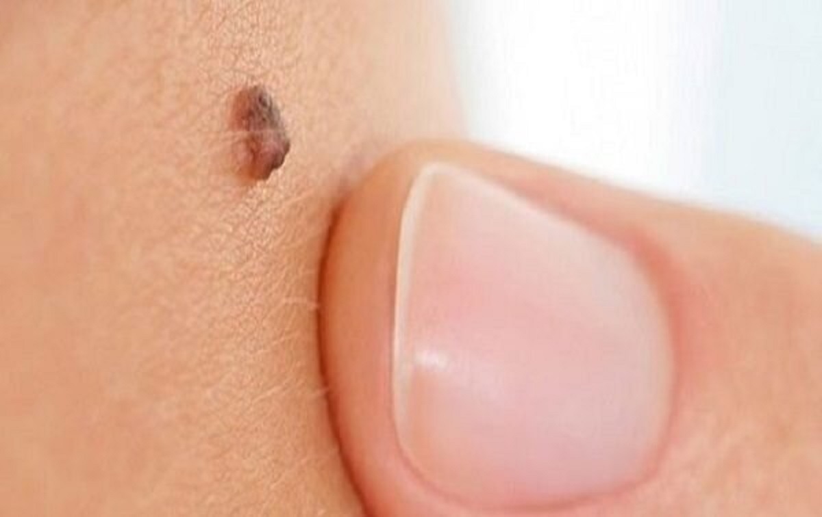 تفاوت خال و زگیل؛ چگونه تشخیص دهیم؟