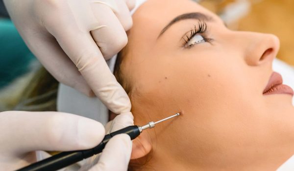 اشتباهات رایج بعد از برداشتن خال