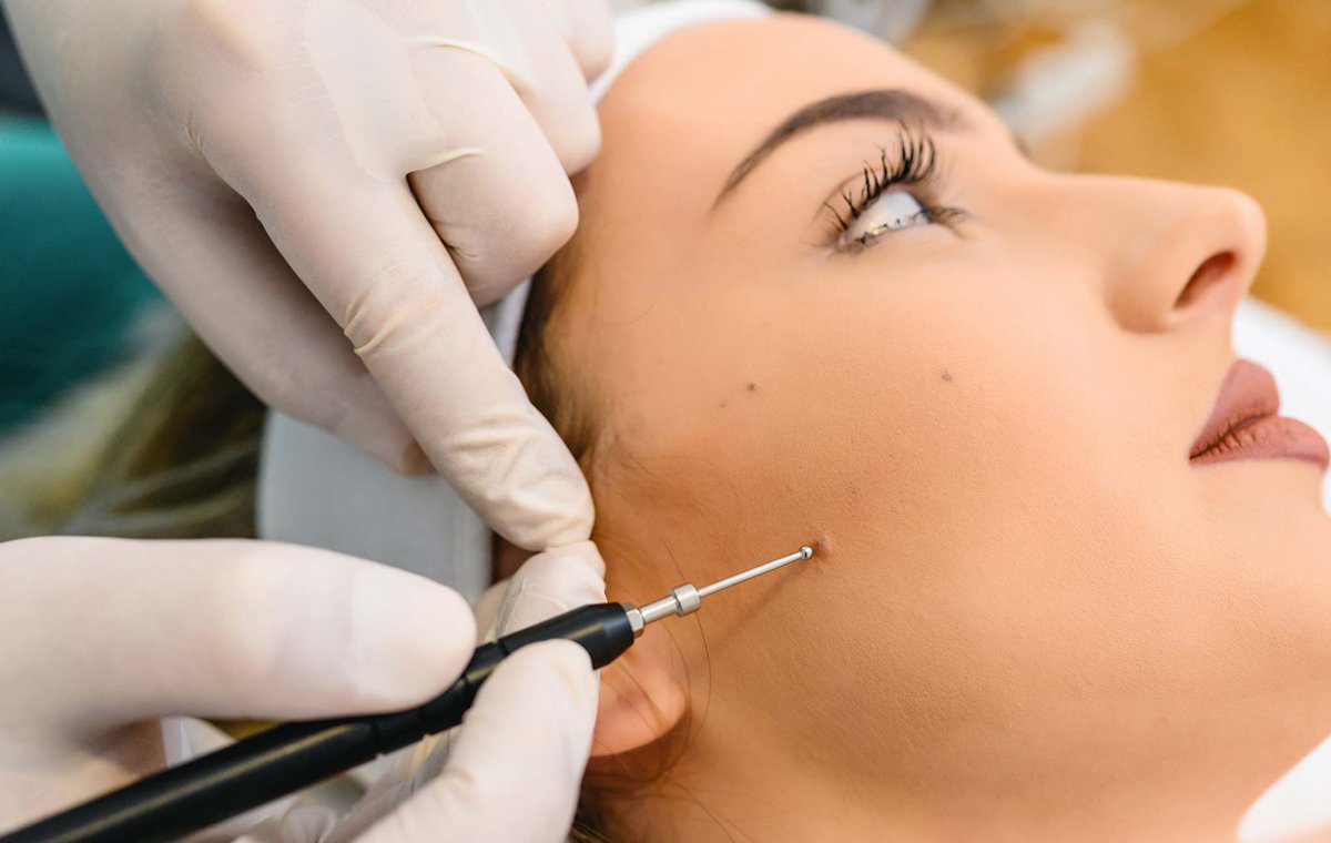 اشتباهات رایج بعد از برداشتن خال