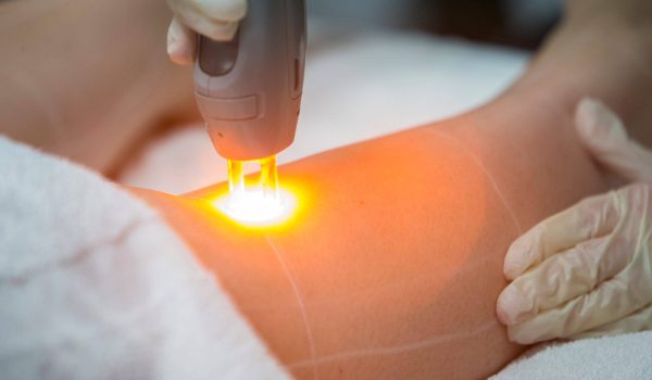 بهترین فاصله بین جلسات لیزر موهای زائد