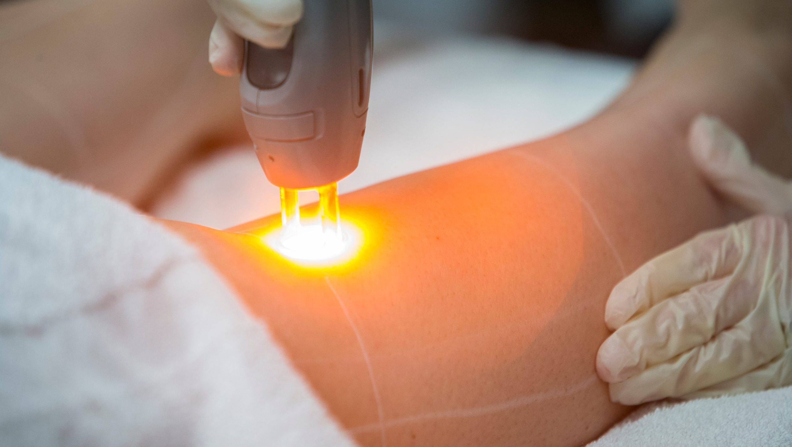 بهترین فاصله بین جلسات لیزر موهای زائد