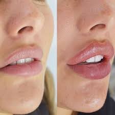 تفاوت ژل لب با بوتاکس لب کدام یک برای شما مناسبتر است؟ بررسی ماندگاری و فواصل زمانی تزریق ژل و بوتاکس