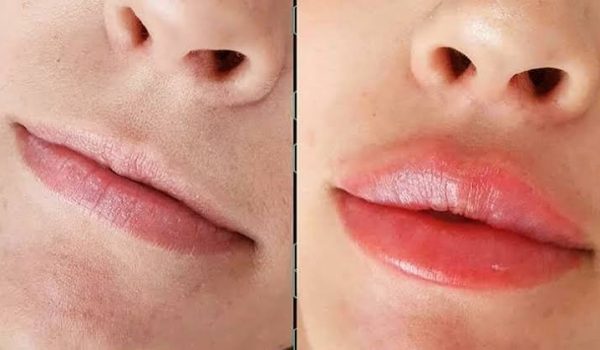 تفاوت ژل لب با بوتاکس لب کدام یک برای شما مناسب‌تر است؟
