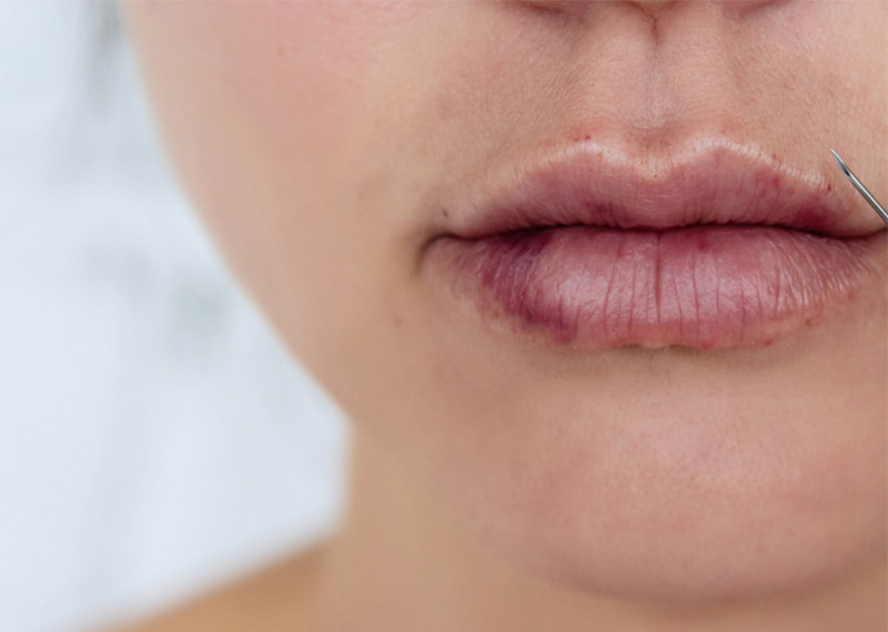 مجله زیبایی علت کبودی بعد از تزریق ژل لب و روش موثر وسریع برای رفع آن