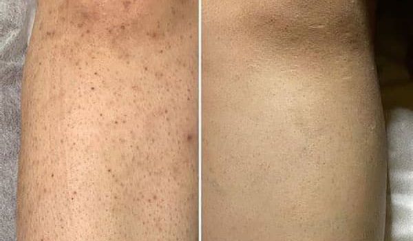 علت برگشت موهای زائد بعد از لیزر چیست؟ + 5 راهکار کاربردی