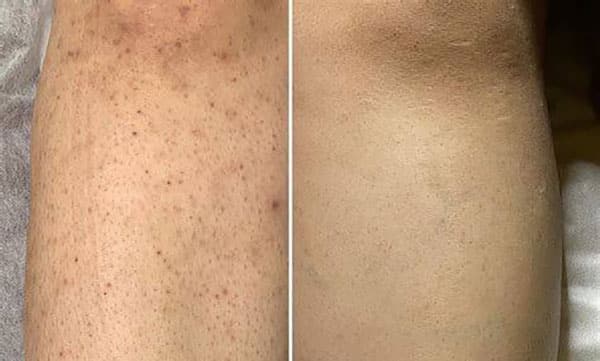مجله زیبایی علت برگشت موهای زائد بعد از لیزر چیست؟ + 5 راهکار کاربردی