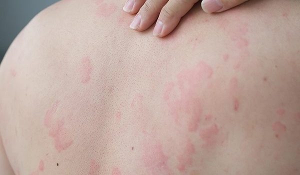 دلایل خارش بعد از لیزر موهای زائد چیست؟