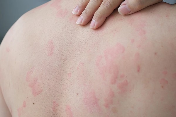 دلایل خارش بعد از لیزر موهای زائد چیست؟